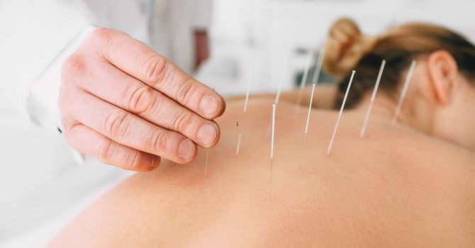 Acupuncture for Headaches: How It Works and When It Helps Most image