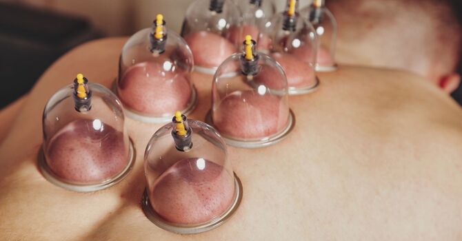 Cupping Therapy Benefits for Chronic Pain Relief and Healing image